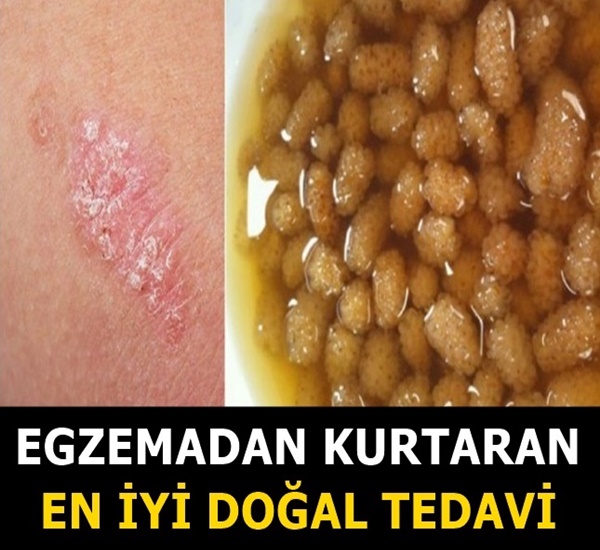 Egzamadan Kurtaran En İyi Doğal Tedavi