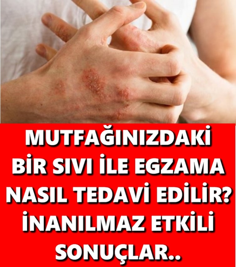 Mutfağınızdaki Bir Sıvı İle Egzama Nasıl Tedavi Edilir! İnanılmaz Etkili Sonuçlar