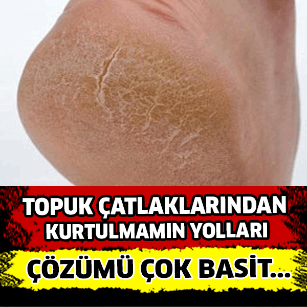 Topuk çatlaklarına karşı doğal yöntem