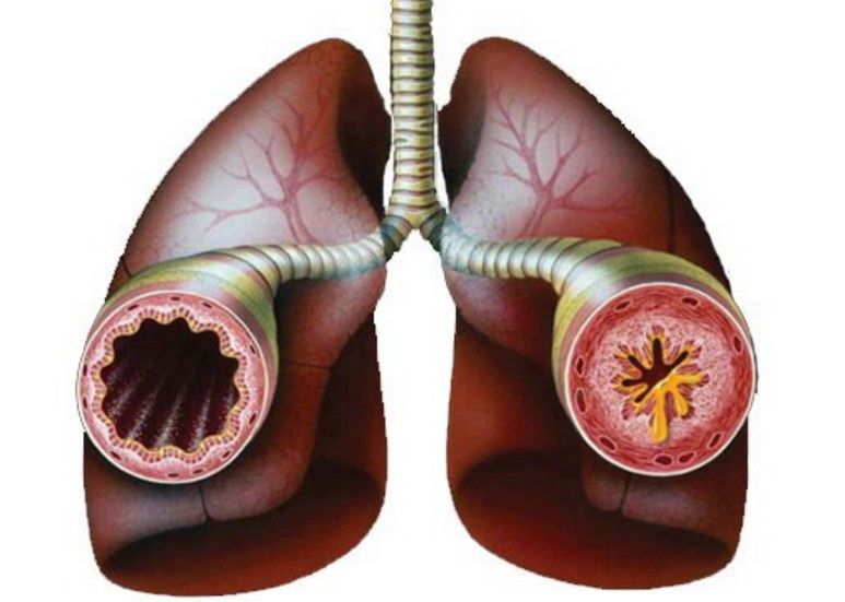 Bronşit ve Öksürükten Kısa Zamanda Kurtulun