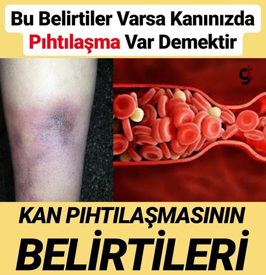 Kan pıhtılaşmasının 8 erken uyarısı...