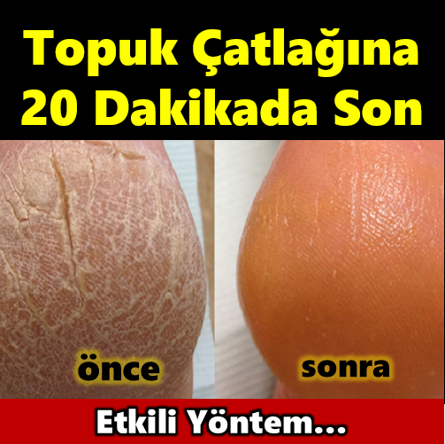 Topuk Çatlağına 20 Dakikada Son