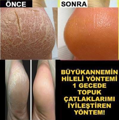 Büyükannem bana bu hileyi söyledi.. Sadece 1 Gecede Çatlak Topuklarımı İyileştirdi