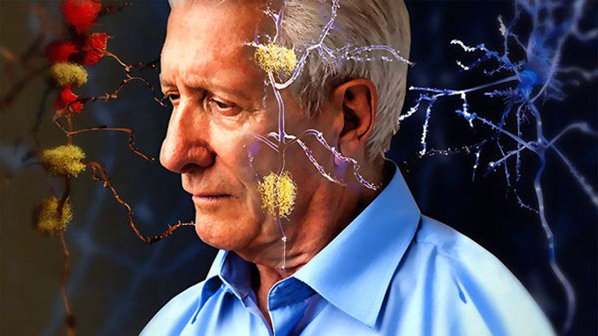 Alzheimer (Alzaymır) Belirtileri 20 Yıl Önceden Başlıyor
