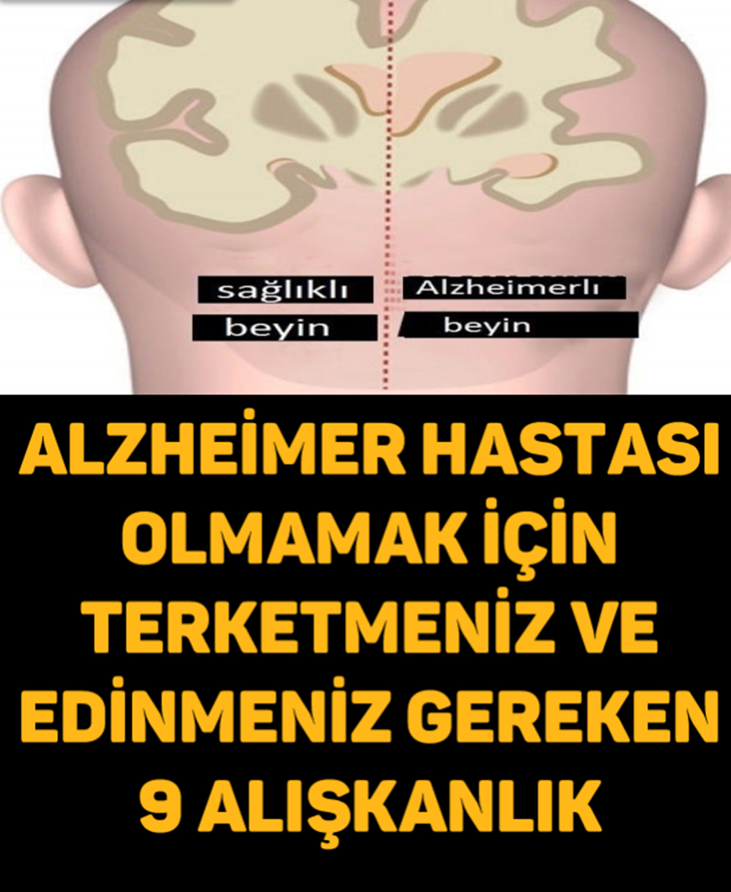 Alzheimer Hastası Olmamak İçin Terketmeniz Ve Edinmeniz Gereken 9 Alışkanlık