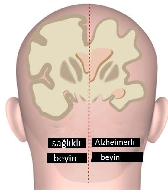 Alzheimer Hastası Olmamak İçin Terketmeniz Ve Edinmeniz Gereken 9 Alışkanlık