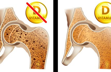 Vücudunuzun D Vitaminine İhtiyaç Duyduğunu Gösteren 8 Belirti