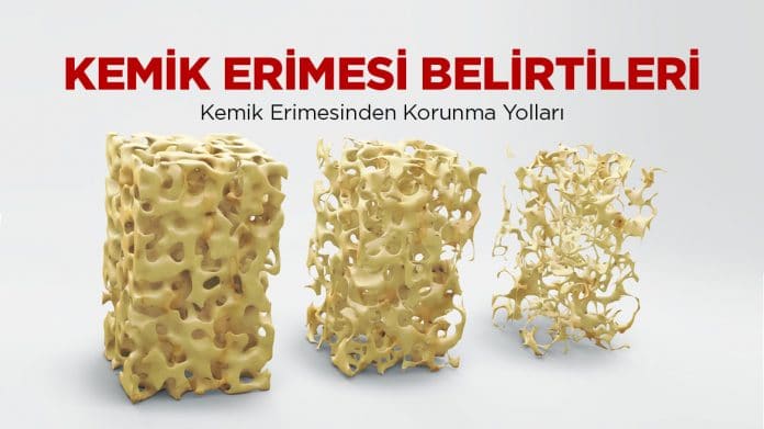 Kemik erimesi nedir belirtileri nelerdir?