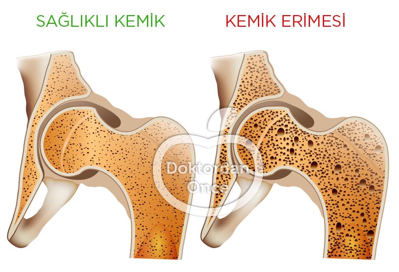Kemik erimesi nedir belirtileri nelerdir?