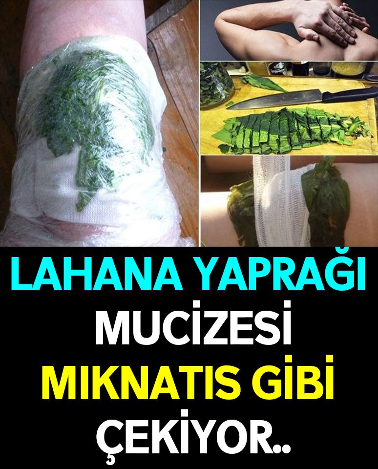 Lahana Yapraklarını Vücudunuza Sarmalısınız