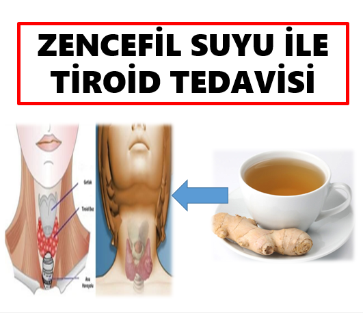 Tiroid Hastalığının Zencefil ile Çözümü