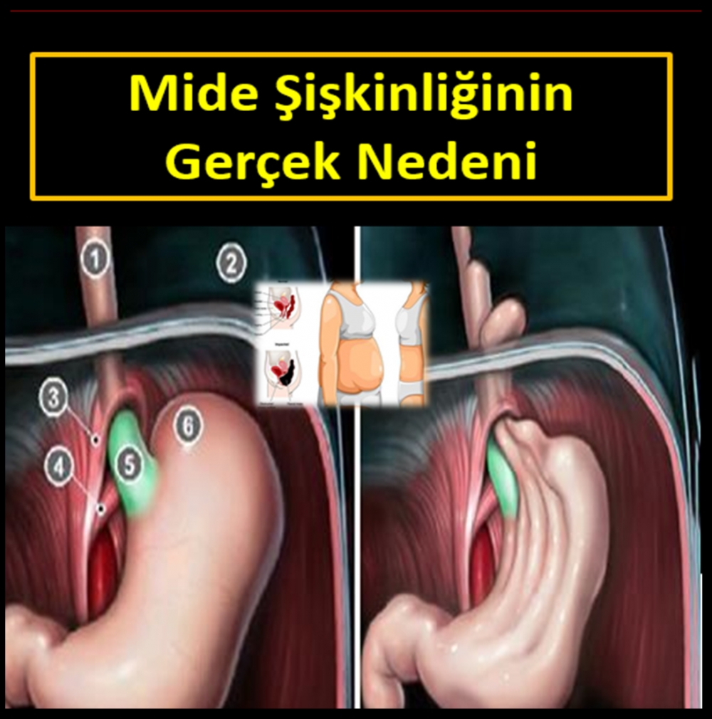 Mide Şişkinliğinin Gerçek Nedeni