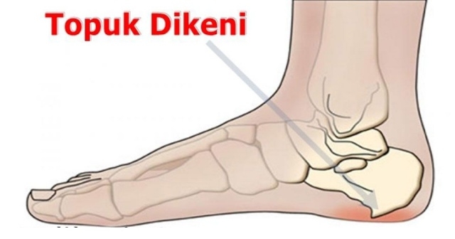 Topuk Dikeni Rahatsızlığına Karşı Doğal Yöntem