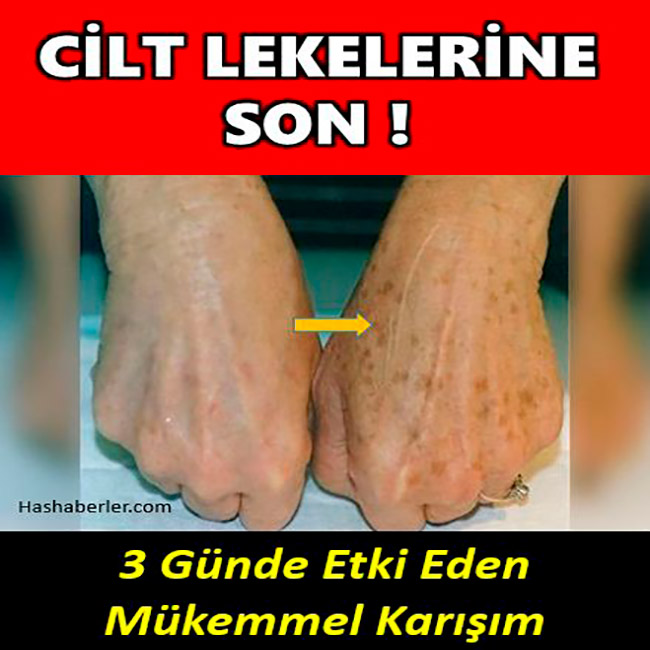 Yaşlılık Lekelerini Soğan Kürüyle 3 Günde Geçirin