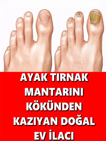 Ayak Tırnak Mantarını Kökünden Kazıyan Doğal Ev İlacı