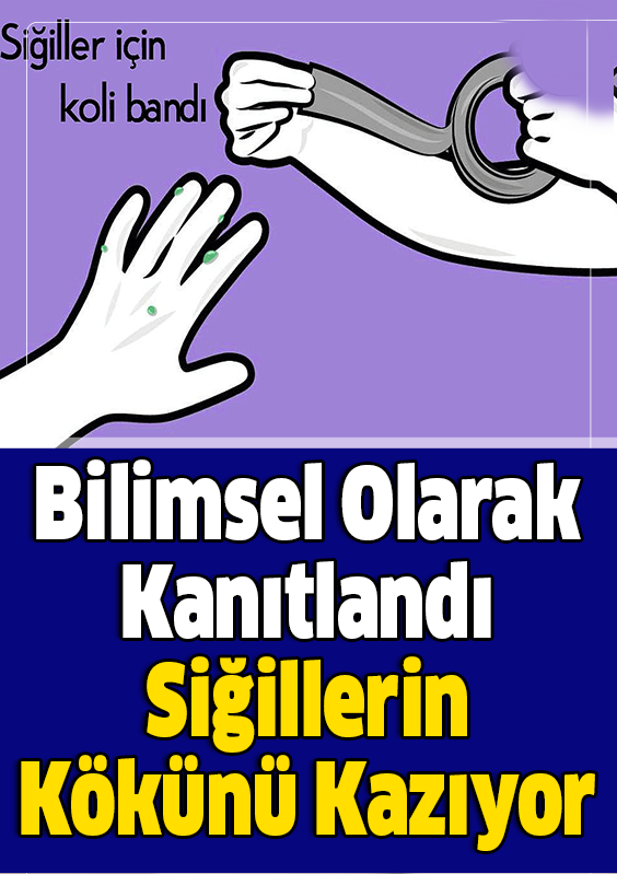 Bilimsel Olarak Kanıtlandı Siğillerin Kökünü Kazıyor