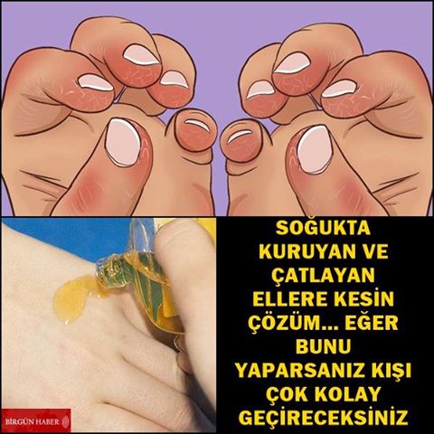 Çatlayan Kuruyan Eller İçin Doğal Çözüm El Çatlaklarına Bitkisel Yöntem