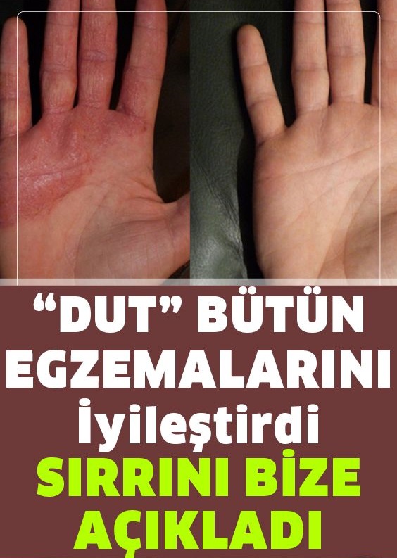 Egzamadan Kurtaran En İyi Doğal Tedavi