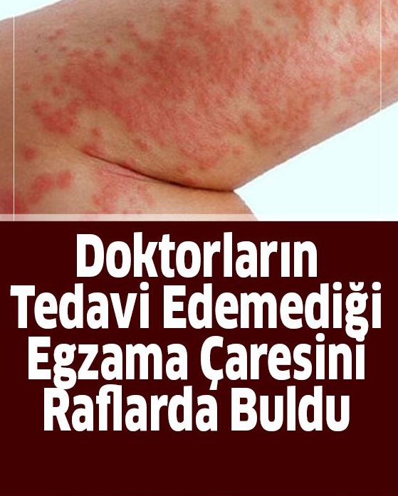 Doktorların Tedavi Edemediği Egzamanın Çaresini Annesi Market Rafında Buldu
