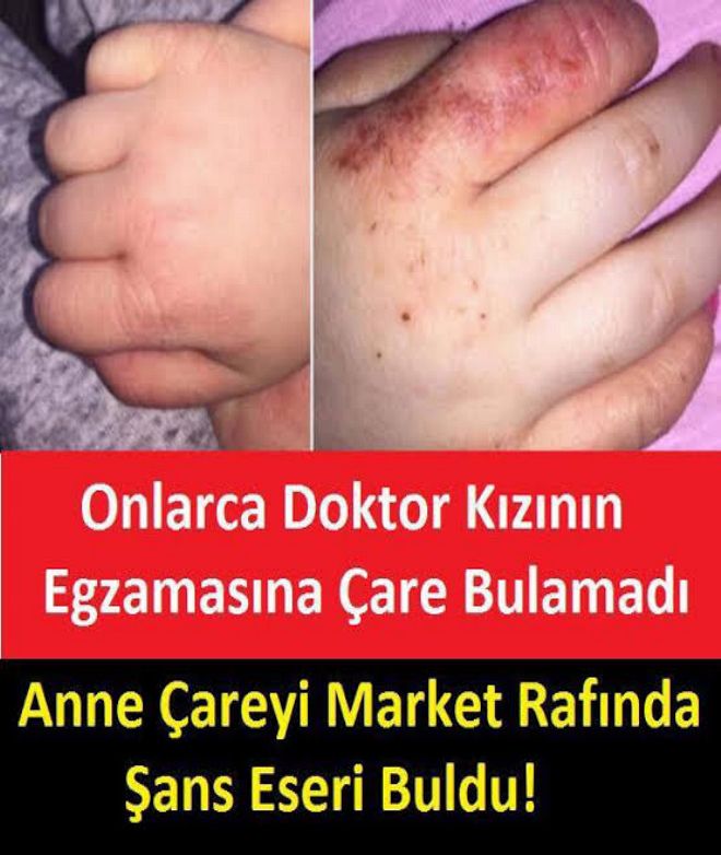Doktorların Tedavi Edemediği Egzamanın Çaresini Annesi Market Rafında Buldu