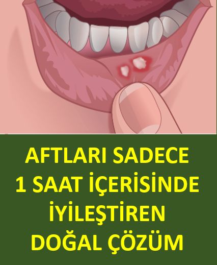 Aftları Sadece 1 Saat İçerisinde İyileştiren Doğal Çözüm